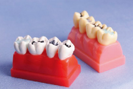 Modello umano dei denti per un modello dimostrativo dell'intarsio e del sigillante di 4 volte a grandezza naturale